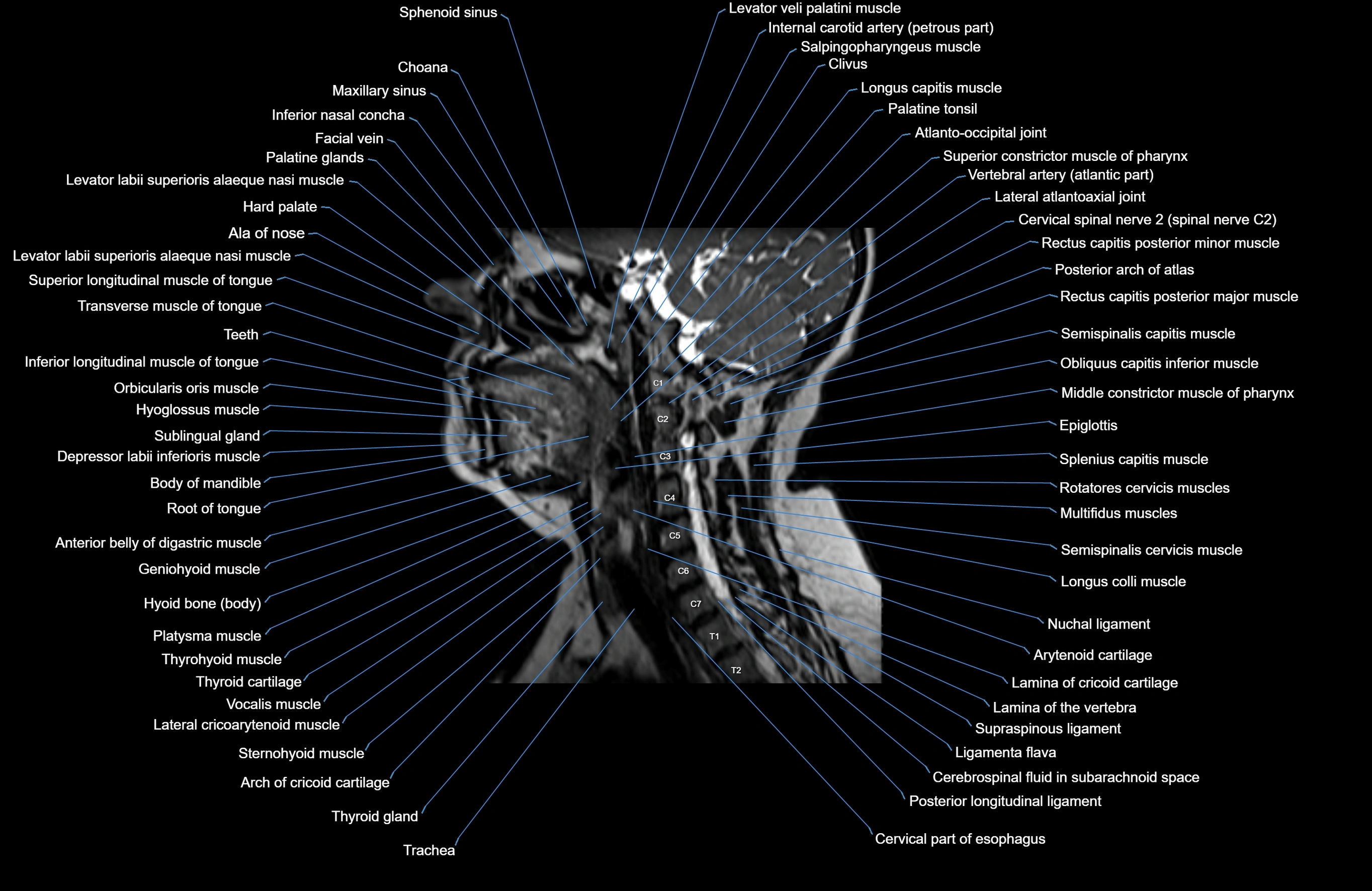 Neck MRI sagittal cross sectional anatomy 3D 1mm 3T radiology  image-img-00001-00010.webp